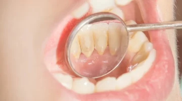 اليكِ كيفية إزالة الجير من أسنانكِ بدون طبيب أسنان